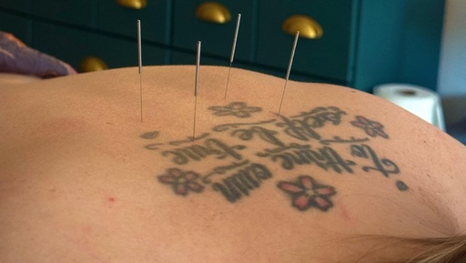 Acupuncture : séances suivantes